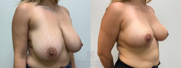 Before & After Breast Reduction Case 645 Right Oblique View in Houston, TX