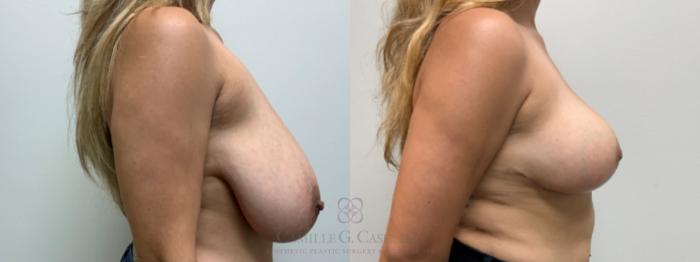 Before & After Breast Reduction Case 645 Right Side View in Houston, TX