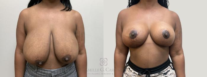 Before & After Breast Reduction Case 664 Front View in Houston, TX