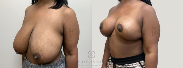Before & After Breast Reduction Case 664 Left Oblique View in Houston, TX