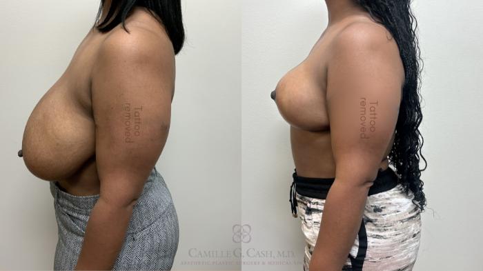 Before & After Breast Reduction Case 664 Left Side View in Houston, TX
