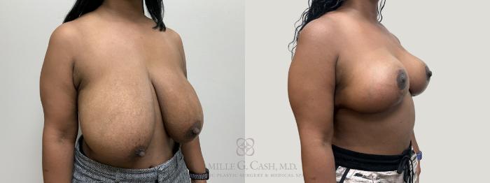 Before & After Breast Reduction Case 664 Right Oblique View in Houston, TX