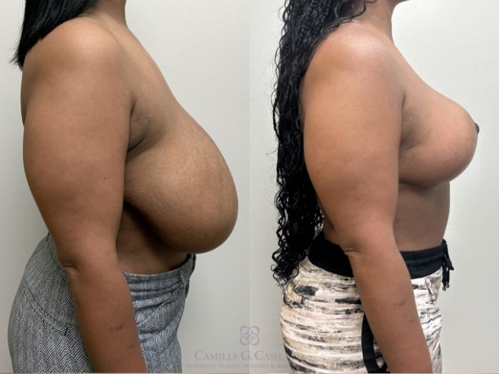 Before & After Breast Reduction Case 664 Right Side View in Houston, TX
