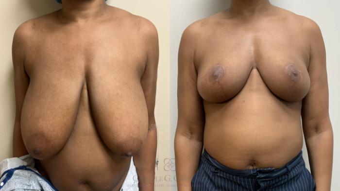 Before & After Breast Reduction Case 665 Front View in Houston, TX