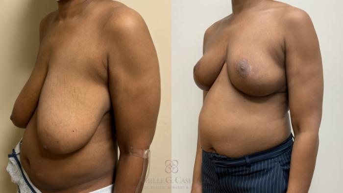 Before & After Breast Reduction Case 665 Left Oblique View in Houston, TX