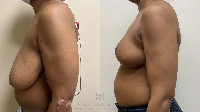 Before & After Breast Reduction Case 665 Left Side View in Houston, TX