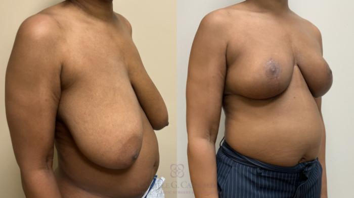 Before & After Breast Reduction Case 665 Right Oblique View in Houston, TX