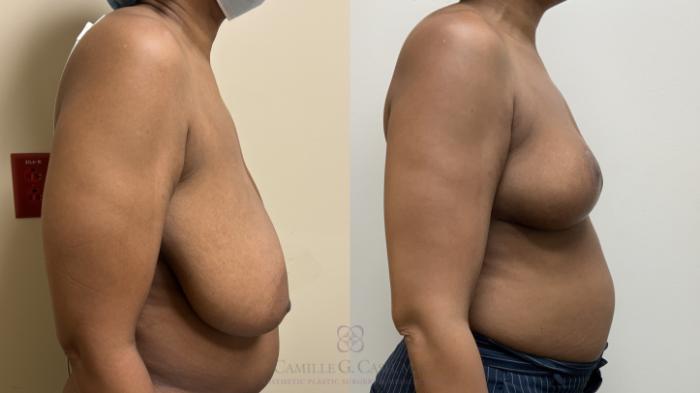 Before & After Breast Reduction Case 665 Right Side View in Houston, TX