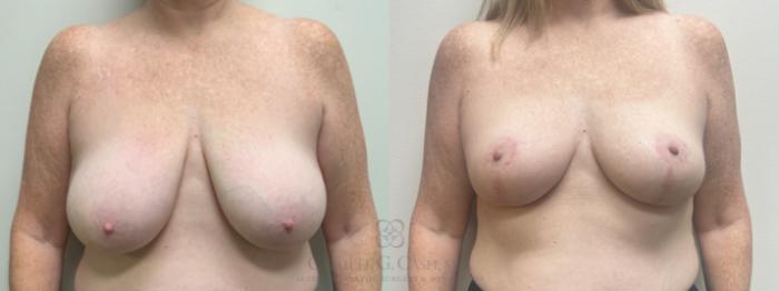 Before & After Breast Reduction Case 686 front 6 month update View in Houston, TX