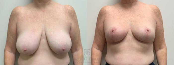 Before & After Breast Reduction Case 686 Front View in Houston, TX