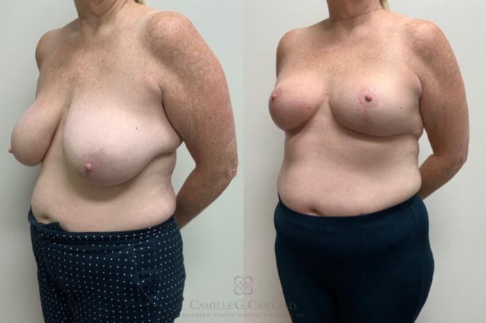 Before & After Breast Reduction Case 686 Left Oblique View in Houston, TX