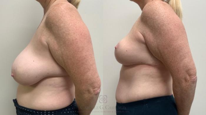 Before & After Breast Reduction Case 686 Left Side View in Houston, TX