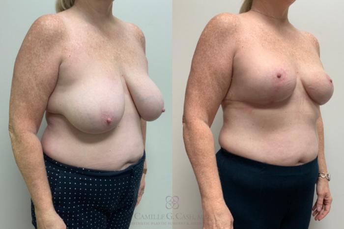 Before & After Breast Reduction Case 686 Right Oblique View in Houston, TX
