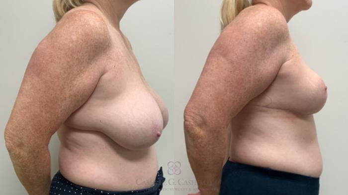 Before & After Breast Reduction Case 686 Right Side View in Houston, TX