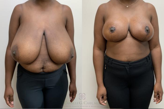 Before & After Breast Reduction Case 694 Front View in Houston, TX