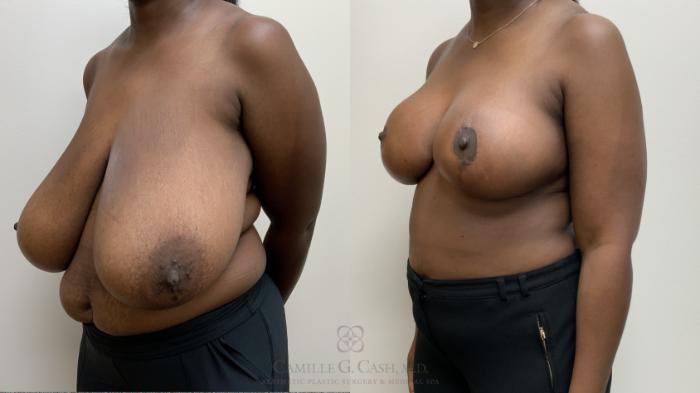Before & After Breast Reduction Case 694 Left Oblique View in Houston, TX
