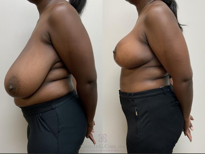 Before & After Breast Reduction Case 694 Left Side View in Houston, TX