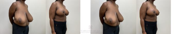 Before & After Breast Reduction Case 694 Right Oblique View in Houston, TX