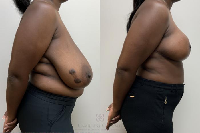 Before & After Breast Reduction Case 694 Right Side View in Houston, TX