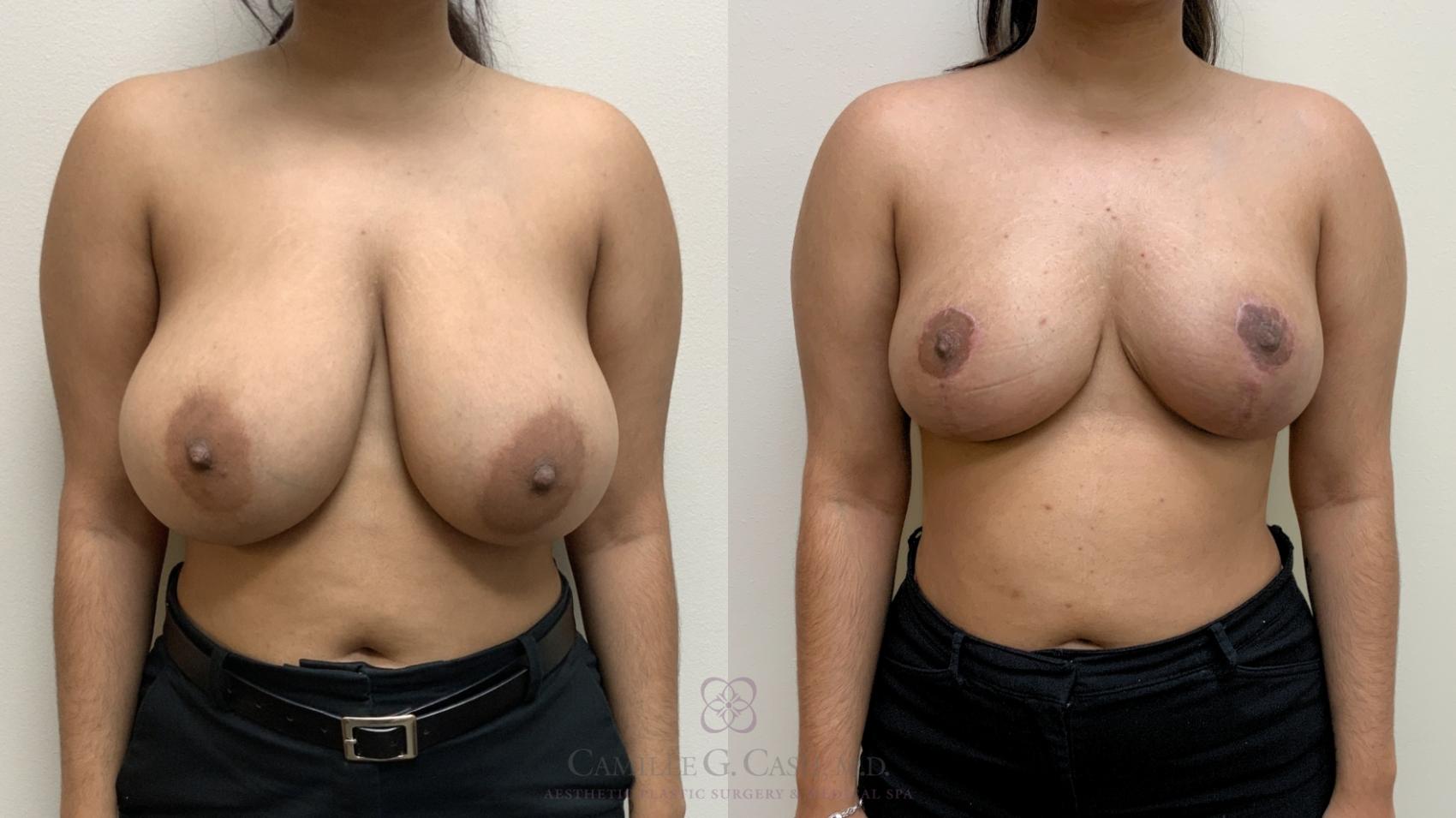 Before & After Breast Reduction Case 699 front 9 weeks View in Houston, TX