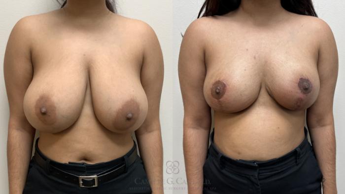 Before & After Breast Reduction Case 699 Front View in Houston, TX