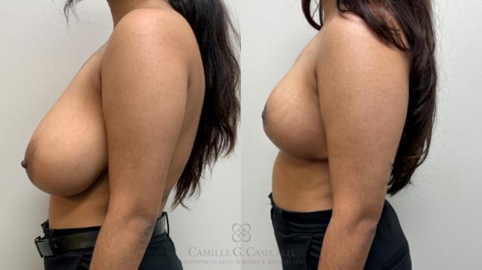 Before & After Breast Reduction Case 699 Left Side View in Houston, TX