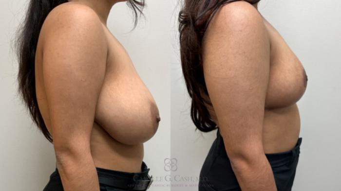 Before & After Breast Reduction Case 699 Right Side View in Houston, TX