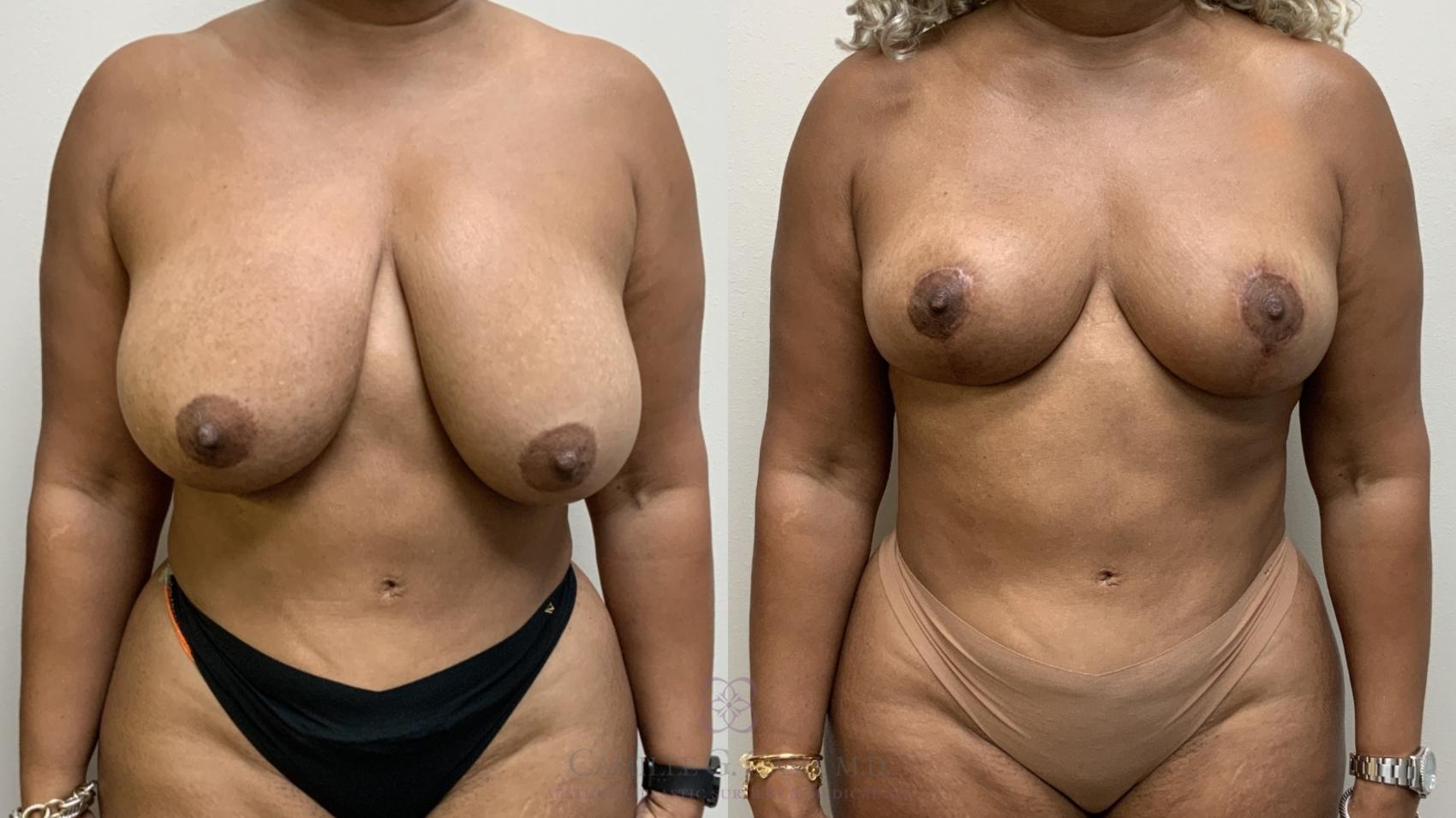 Before & After Breast Reduction Case 701 Front View in Houston, TX