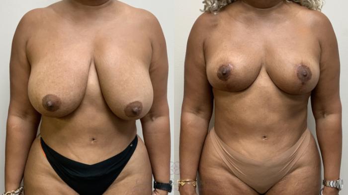 Before & After Breast Reduction Case 701 Front View in Houston, TX