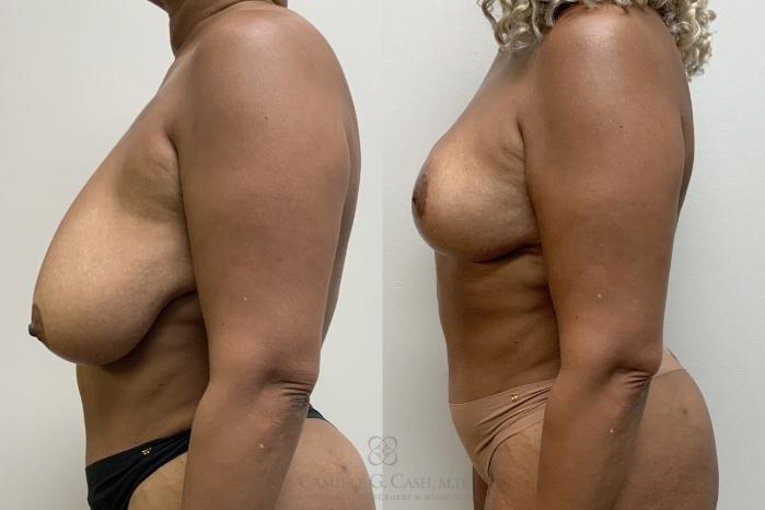 Before & After Breast Reduction Case 701 Left Side View in Houston, TX