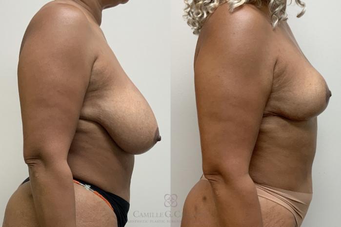 Before & After Breast Reduction Case 701 Right Side View in Houston, TX