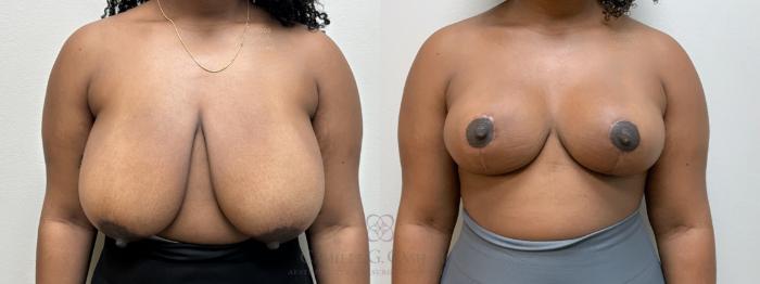 Before & After Breast Reduction Case 703 front 2 View in Houston, TX