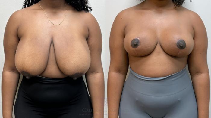 Before & After Breast Reduction Case 703 Front View in Houston, TX