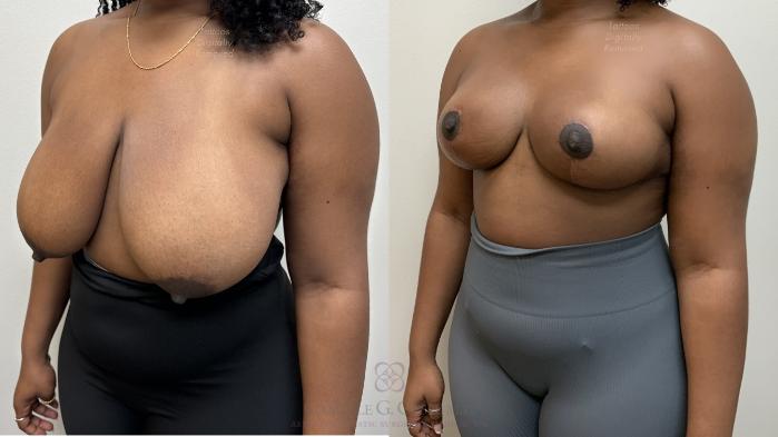 Before & After Breast Reduction Case 703 Left Oblique View in Houston, TX