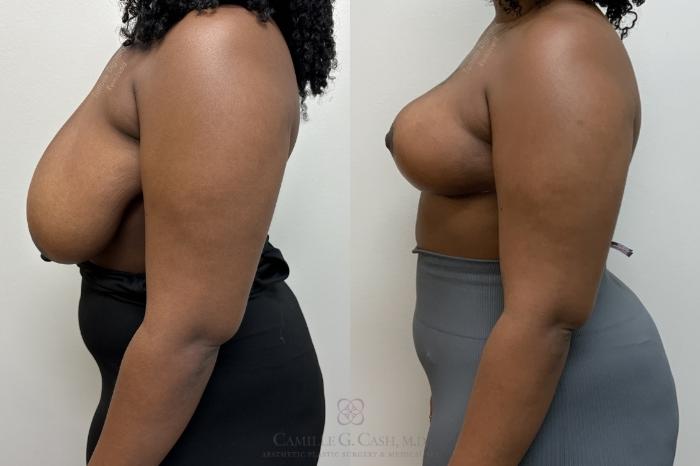 Before & After Breast Reduction Case 703 Left Side View in Houston, TX