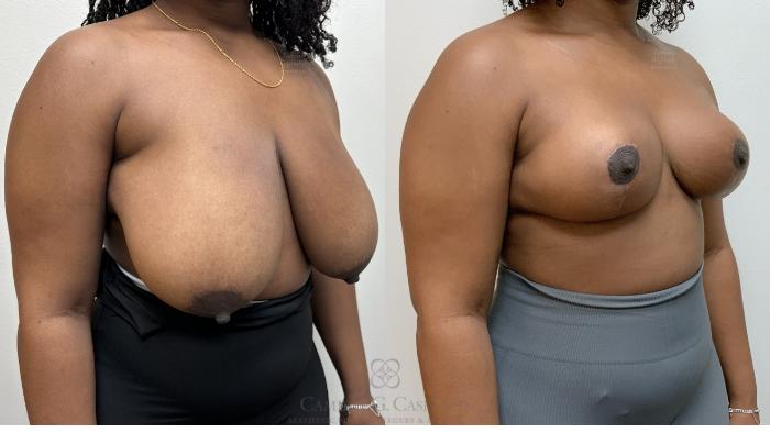 Before & After Breast Reduction Case 703 Right Oblique View in Houston, TX