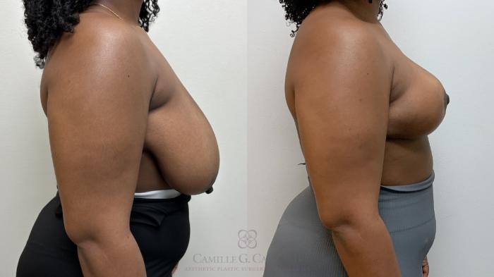 Before & After Breast Reduction Case 703 Right Side View in Houston, TX