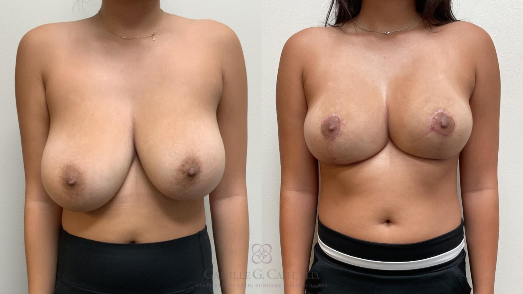 Before & After Breast Reduction Case 705 Front View in Houston, TX