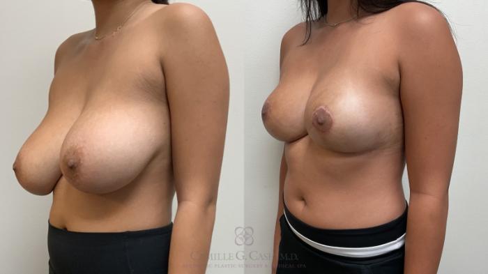 Before & After Breast Reduction Case 705 Left Oblique View in Houston, TX