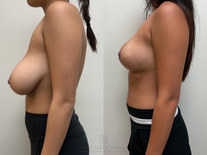 Before & After Breast Reduction Case 705 Left Side View in Houston, TX