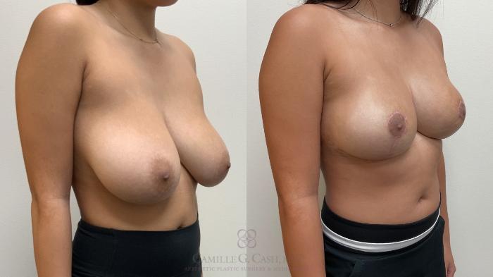 Before & After Breast Reduction Case 705 Right Oblique View in Houston, TX