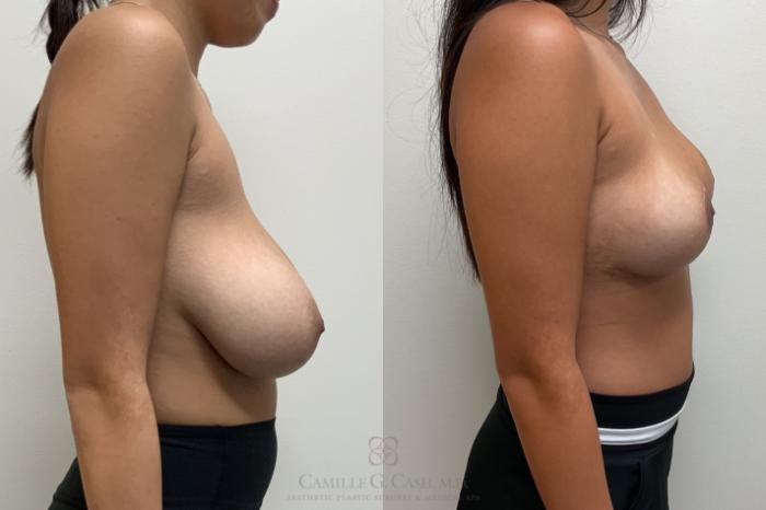 Before & After Breast Reduction Case 705 Right Side View in Houston, TX