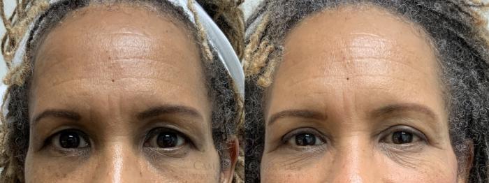 Before & After Eyelid Surgery Case 692 Front View in Houston, TX