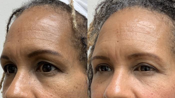 Before & After Brow Lift Case 692 Left Oblique View in Houston, TX