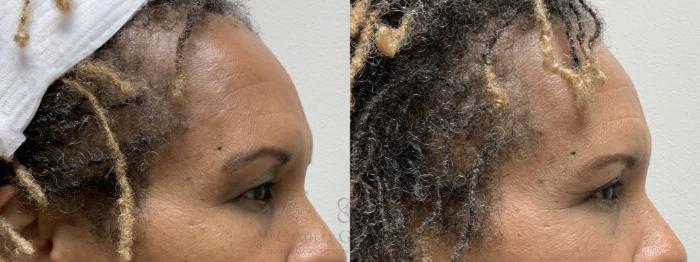 Before & After Eyelid Surgery Case 692 Right Side View in Houston, TX