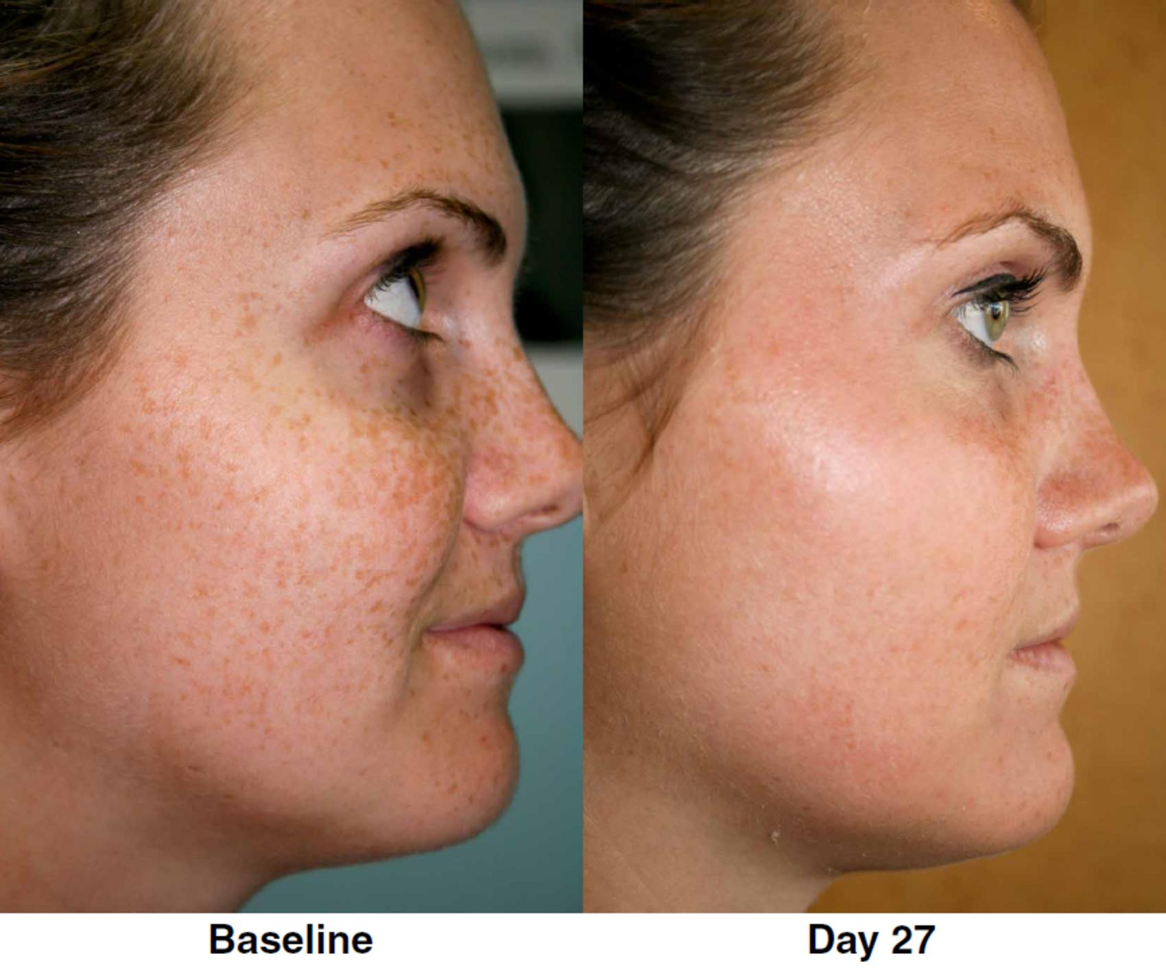 Chemical Peel Before & After