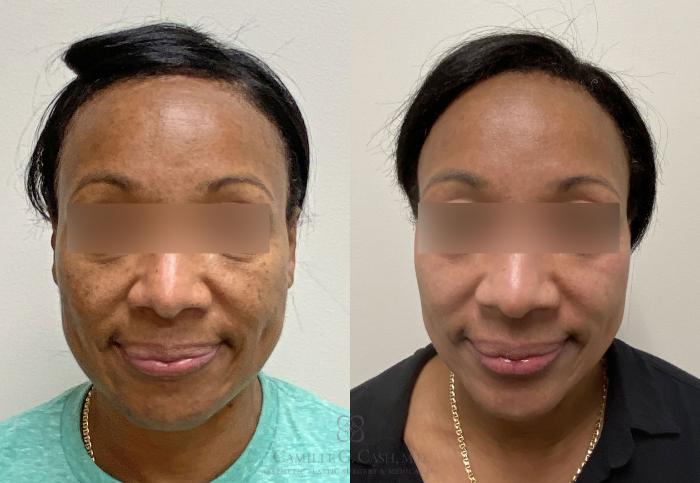 Before & After Melanage Peel Case 388 View #1 View in Houston, TX