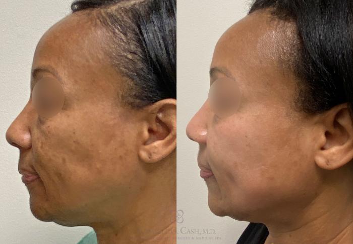 Before & After Melanage Peel Case 388 View #2 View in Houston, TX