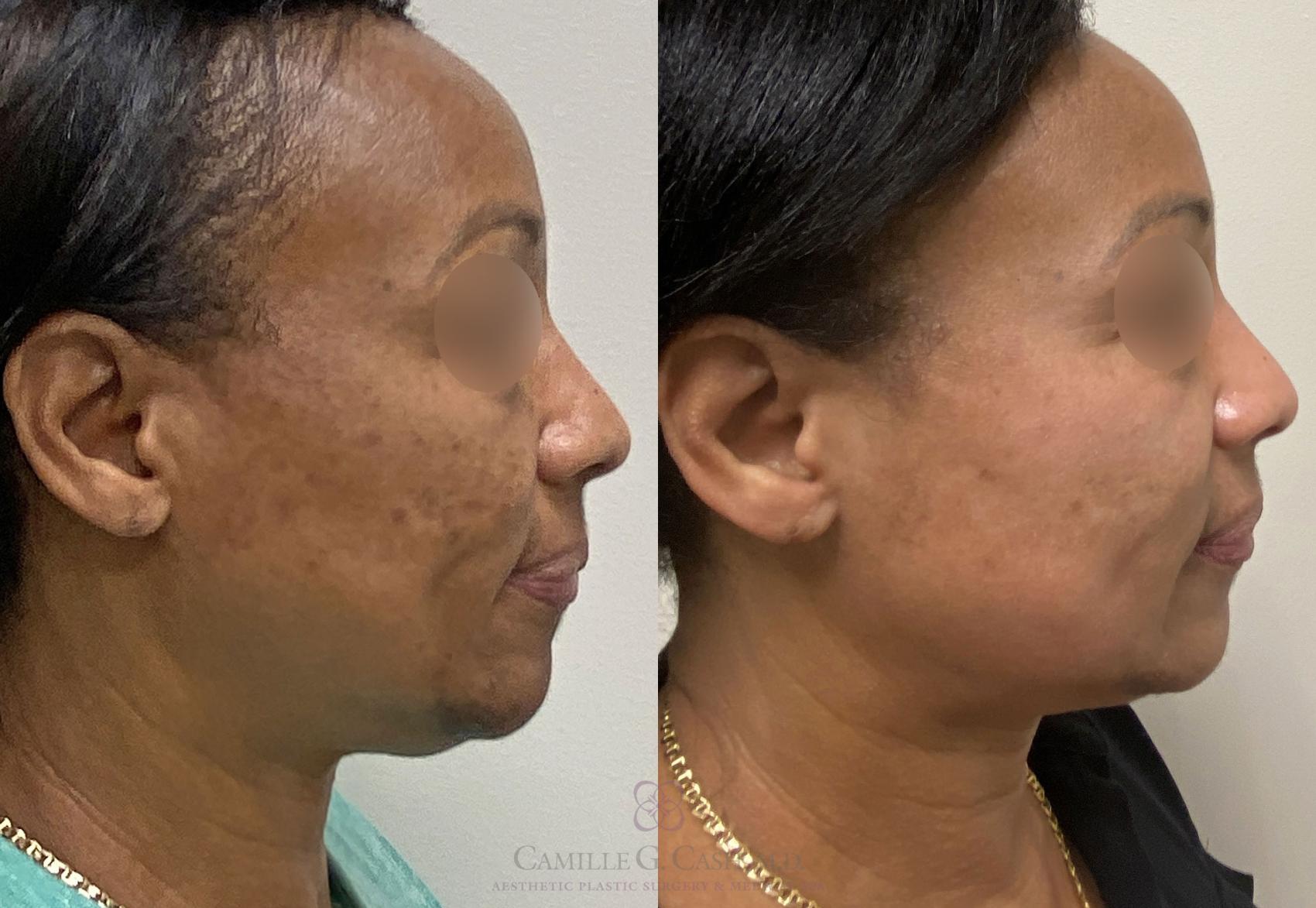 Before & After Chemical Peels Case 388 View #3 View in Houston, TX