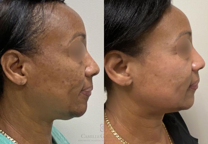 Before & After Melanage Peel Case 388 View #3 View in Houston, TX